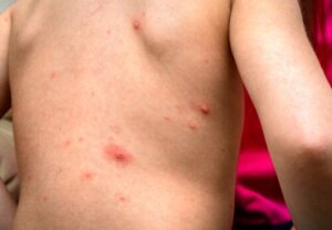 Eruzioni cutanee più frequenti nei bambini in base alla loro età