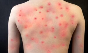 Vaiolo delle scimmie nei bambini: tutto ciò che bisogna sapere