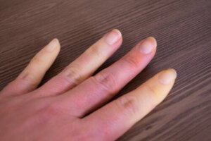 Cos'è la sindrome di Raynaud?