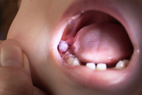 Cisti dentale nei bambini: come trattarla