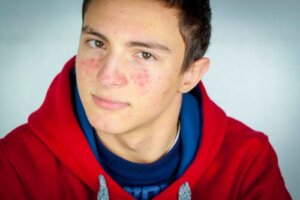 Adolescenti e acne: cosa fare e cosa evitare