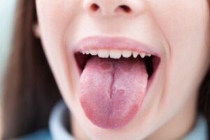 6 malattie infantili con manifestazioni sulla lingua