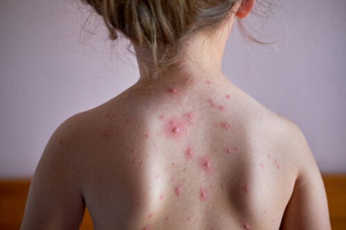 Herpes Zoster: cos'è e come colpisce i bambini