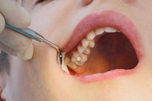 Le carie nei denti da latte e nei denti permanenti