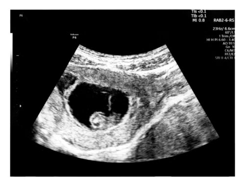 Ecografia a 6 settimane di gravidanza: cosa si vede?