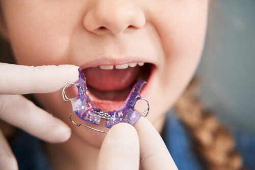 Quando bisogna iniziare con l'ortodonzia?