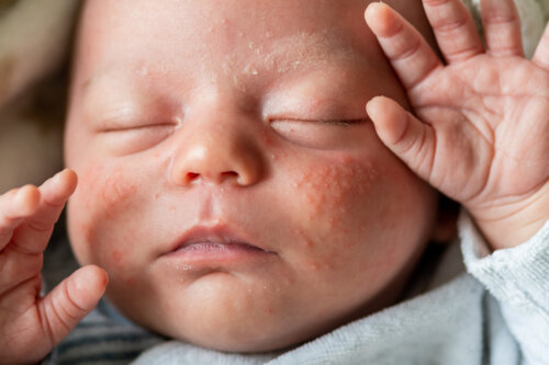 Pelle reattiva del bambino e del neonato