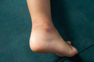 Punture a mare ai bambini: cosa fare in ogni caso?