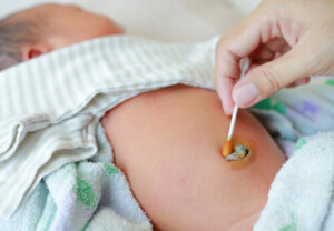 Onfalite o infezione dell'ombelico nel neonato