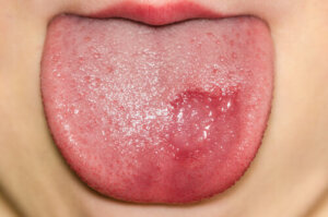 Come capire se un bambino ha un fungo sulla lingua