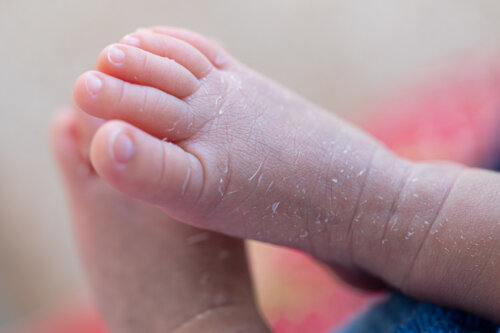 Pelle screpolata nel bambino: cause e prevenzione