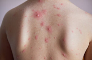 I segni della varicella: come prevenirli e attenuarli