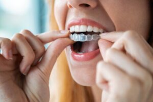 Come pulire gli apparecchi ortodontici rimovibili