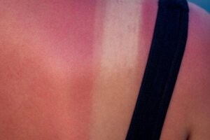 Scottature in gravidanza: rischi e trattamento