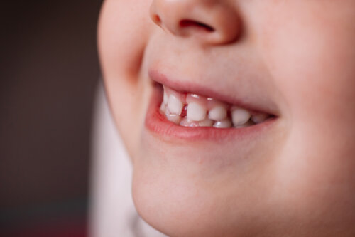 Se i denti da latte di vostro figlio non cadono, cosa fare?