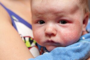 Petecchie nel bambino: sintomi, cause e trattamento