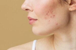 Acne postpartum: cause e trattamento