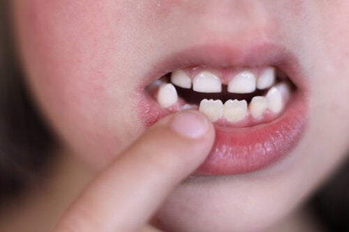 Denti con mammelloni nei bambini: è normale?