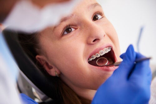 Ortodonzia precoce nei bambini: espansione o estrazioni dentarie?