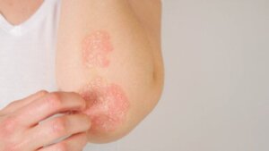 Psoriasi e gravidanza: cosa dovreste sapere