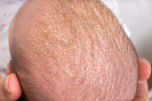 Crosta lattea: come rimuoverla dalla testa del bambino?