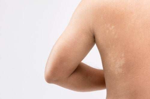 Tinea Versicolor nei neonati e nei bambini: cause, sintomi, trattamento