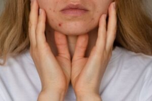 Acne in adolescenza: perché compare?