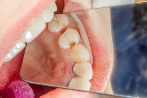 Denti da latte con carie: è meglio restaurarli che toglierli?