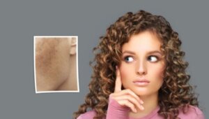 Macchie sul viso in gravidanza: come trattarle?