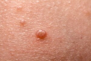 Mollusco contagioso nei bambini: cosa bisogna sapere