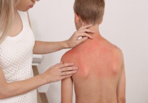 Scottature solari nei neonati e nei bambini: cosa dovresti sapere