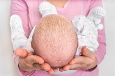 Dermatite seborroica infantile e crosta lattea